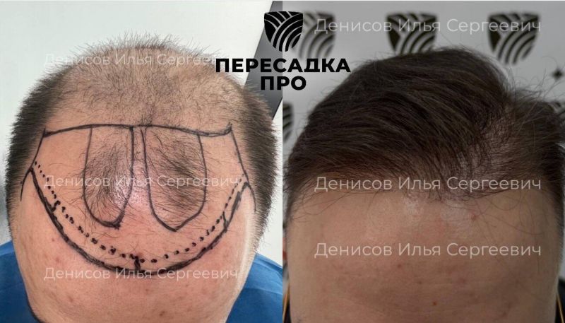 6–7 степень облысения, пересажено 5000 графтов, результат через 12 месяцев после второго этапа