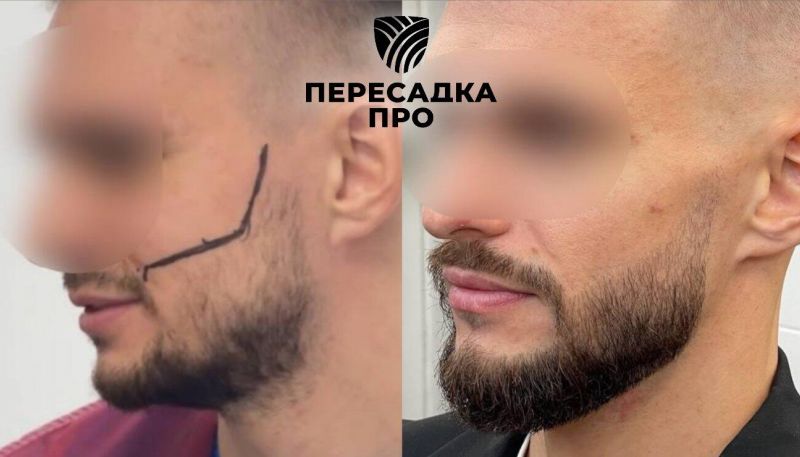 Эстетическая коррекция бороды, пересажено 1500 графтов, результат через 12 месяцев