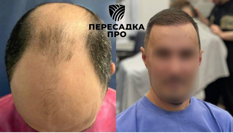 7 степень облысения, пересажено 6000 графтов, результат через 12 месяцев после второго этапа
