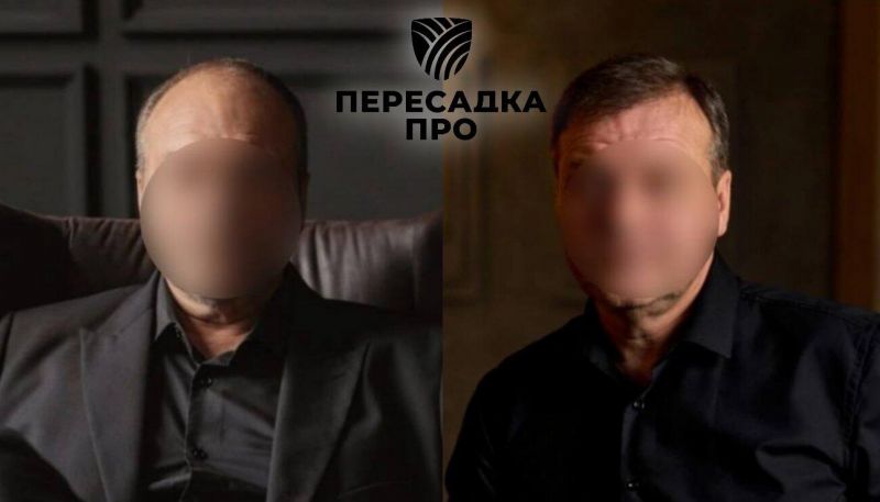 5 степень облысения, пересажено 4500 графтов, результат через 12 месяцев