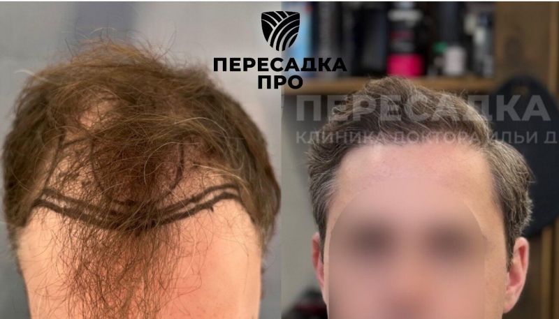 5 степень облысенния,  пересажено 6000 графтов, результат через 12 месяцев