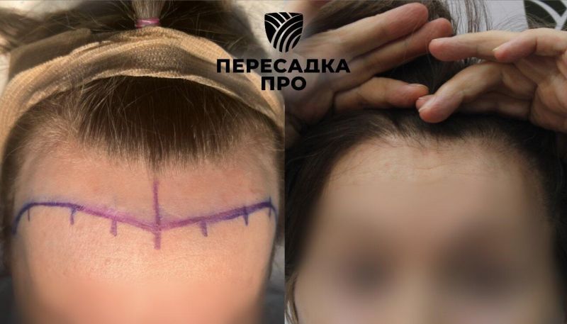 Отсутствует степень облысения, пересажено 3500 графтов, результат через 12 месяцев