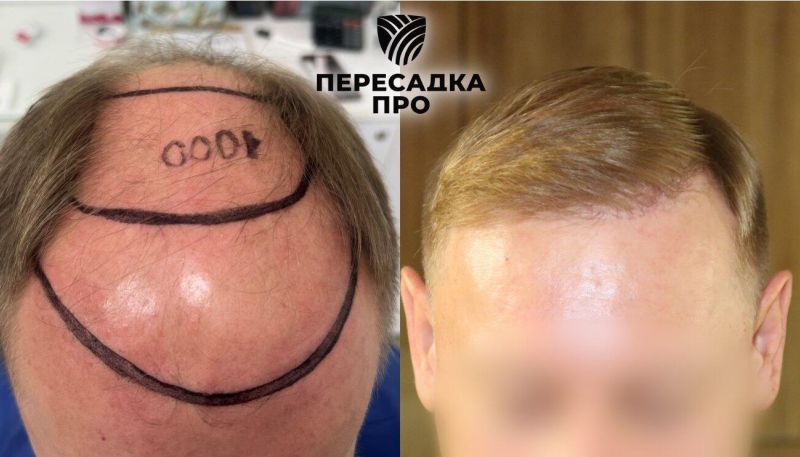 6 степень облысения, пересажено 5000 графтов, результат через 12 месяцев