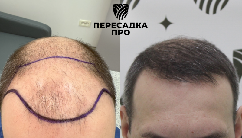 6 степень облысения, пересажено 3500 графтов, результат через 12 месяцев
