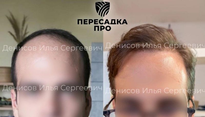 5 степень облысения, пересажено 3500 графтов, результат через 8 месяцев