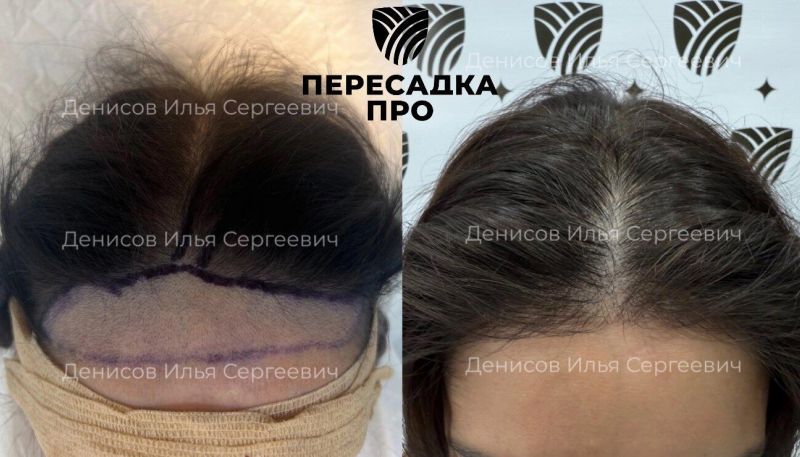 1–2 степень облысения по Людвигу, пересажено 2500 графтов, результат через 8 месяцев