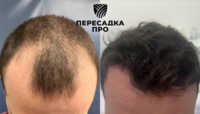 4 степень облысения, пересажено 3500 графтов, результат через 12 месяцев