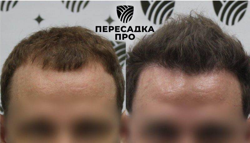 3 степень облысения, пересажено 4000 графтов, результат через 5 месяцев