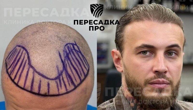 отсутствует степень облысения, пересажено 3500 графтов, результат через 12 месяцев