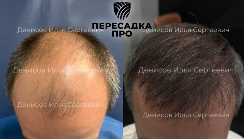 6 степень облысения, пересажено 6000 графтов, результат через 12 месяцев после второго этапа