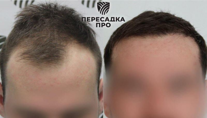 2–3 степень облысения, пересажено 3500 графтов, результат через 3 месяца