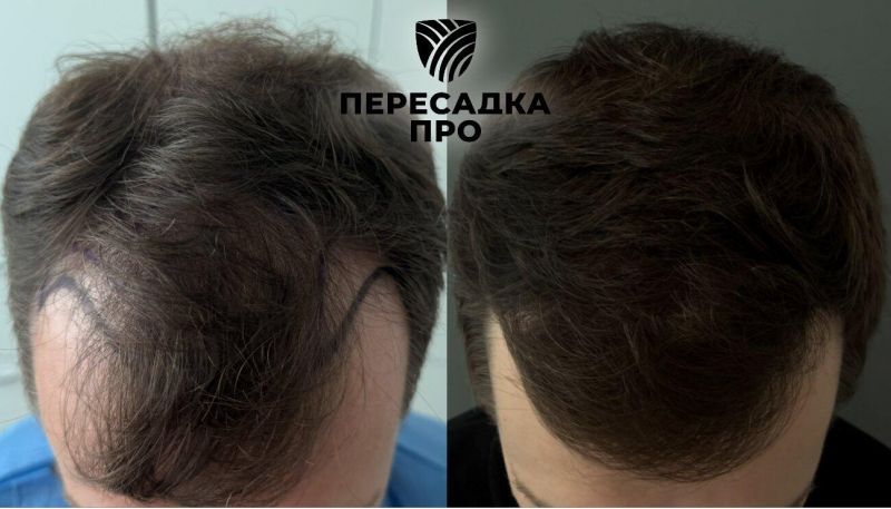 4 степень облысения, пересажено 4500 графтов, результат через 7 месяцев