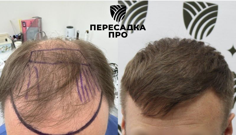 6 степень облысения, пересажено 7800 графтов, результат через 9 месяцев после второго этапа