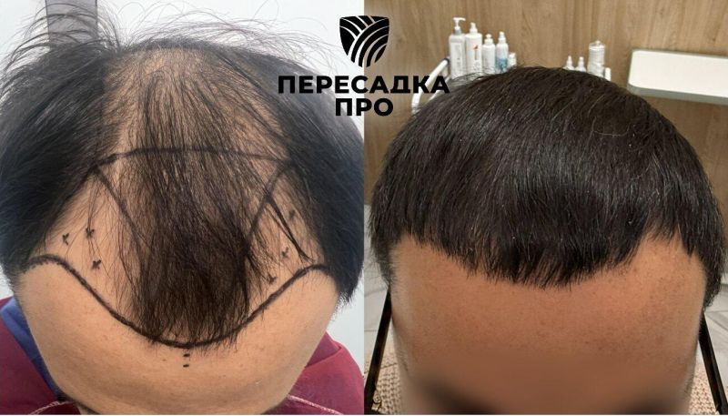4 степень облысения, пересажено 3500 графтов, результат через 2 года