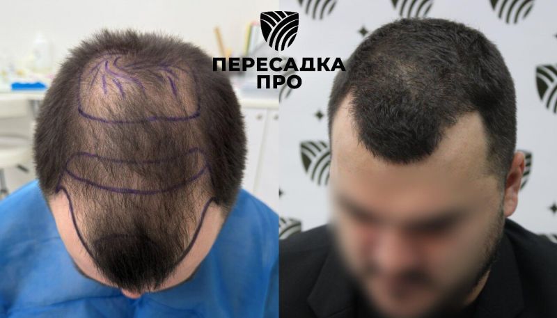 4 степень облысения, пересажено 5000 графтов, результат через 7 месяцев