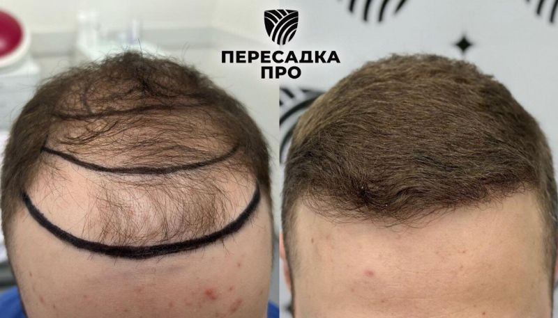 5 степень облысения, пересажено 4500 графтов, результат через 9 месяцев