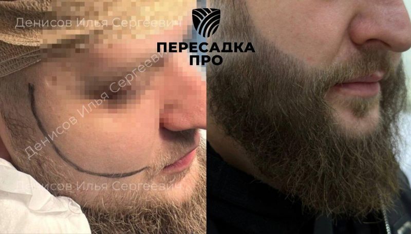 Эстетическая коррекция бороды, пересажено 2500 графтов, результат через 12 месяцев