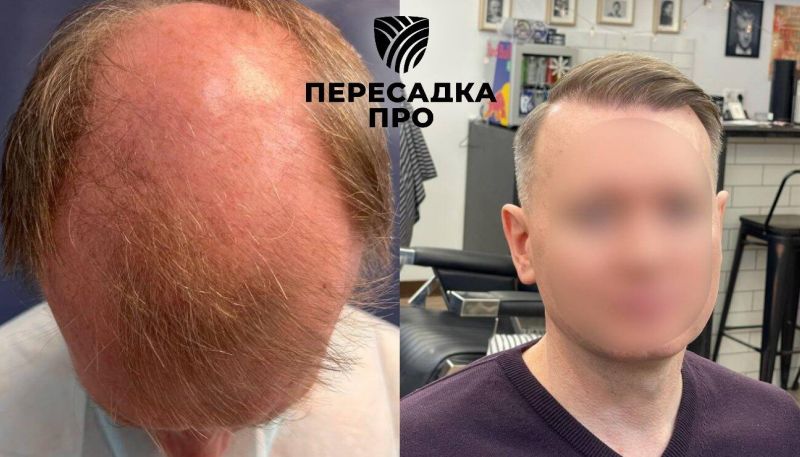 7 степень облысения, пересажено 6000 графтов, результат через 12 месяцев после второго этапа
