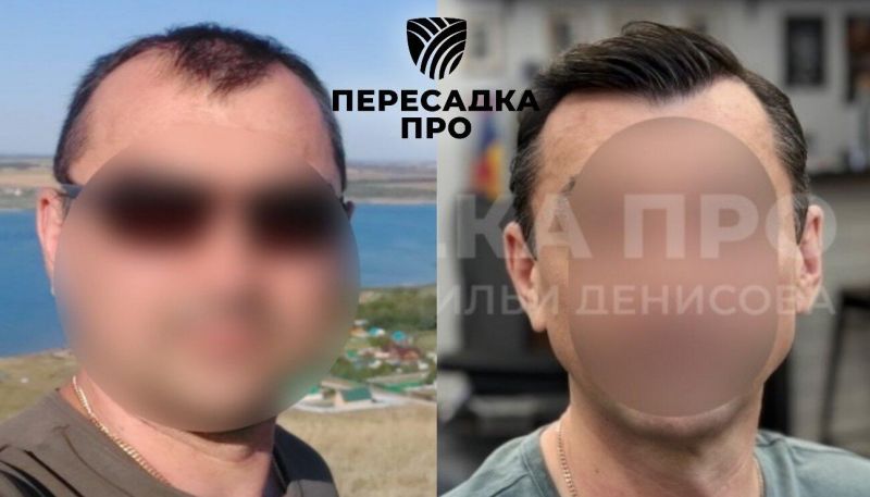 4 степень облысения, пересажено 5000 графтов, результат через 12 месяцев