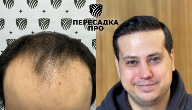 4 степень облысения, пересажено 5500 графтов, результат через 9 месяцев