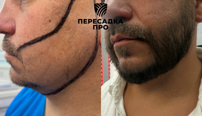 Эстетическая коррекция бороды, пересажено 3500 графтов, результат через 12 месяцев