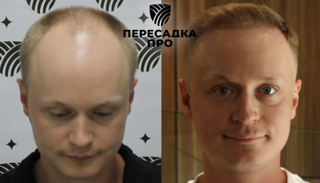 5–6 степень облысения, пересажено 6000 графтов, результат через 9 месяцев