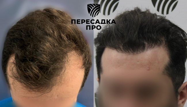 3 степень облысения, пересажено 3500 графтов, результат через 12 месяцев