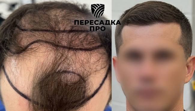 5 степень облысения, пересажено 5000 графтов, результат через 9 месяцев