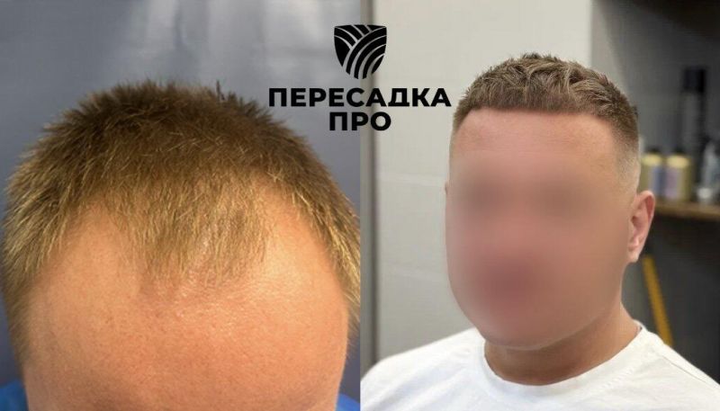 отсутствует степень облысения, пересажено 4500 графтов, результат через 7 месяцев