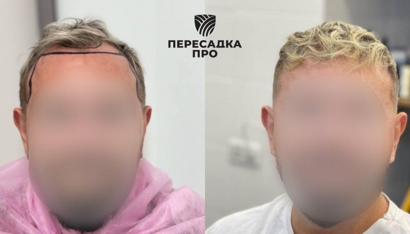 3 степень облысения, пересажено 3000 графтов, результат через 12 месяцев