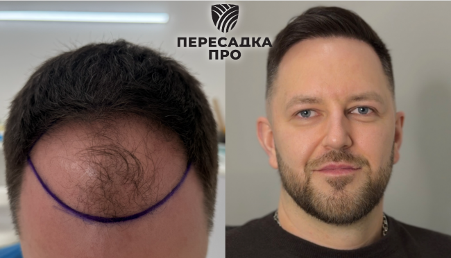 2–3 степень облысения, пересажено 3000 графтов, результат через 12 месяцев
