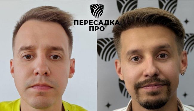 Отсутствует степень облысения, пересажено 3000 графтов, результат через 12 месяцев