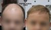 6 степень облысения, пересажено 6000 графтов, результат через 9 месяцев