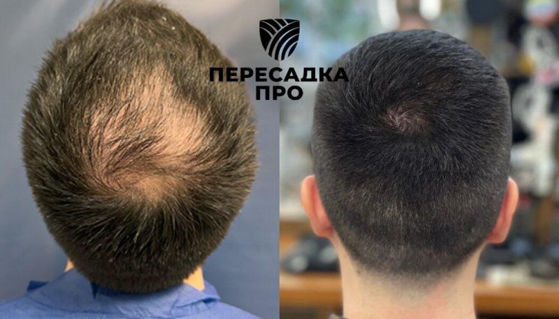 3 степень облысения, пересажено 2500 графтов, результат через 6 месяцев