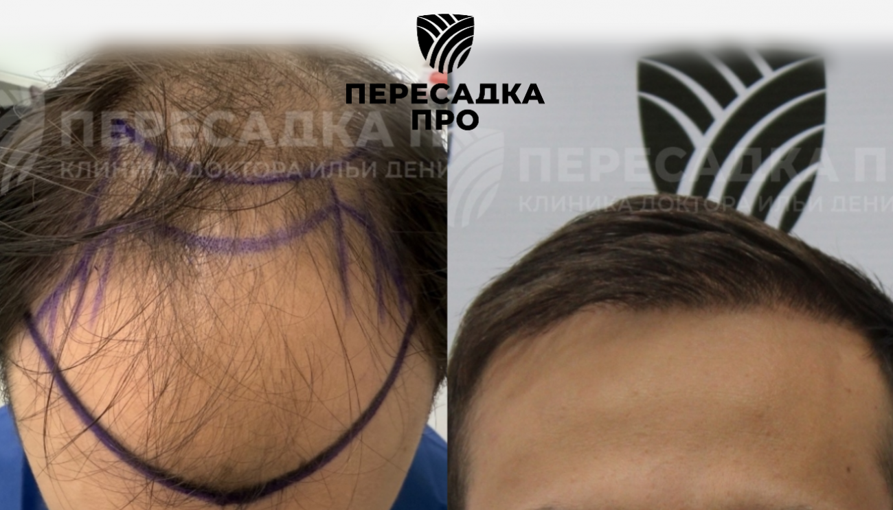 5 степень облысения, пересажено 3500 графтов, результат через 12 месяцев