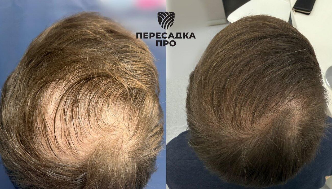 3 степень облысения, пересажено 2000 графтов, результат через 8 месяцев