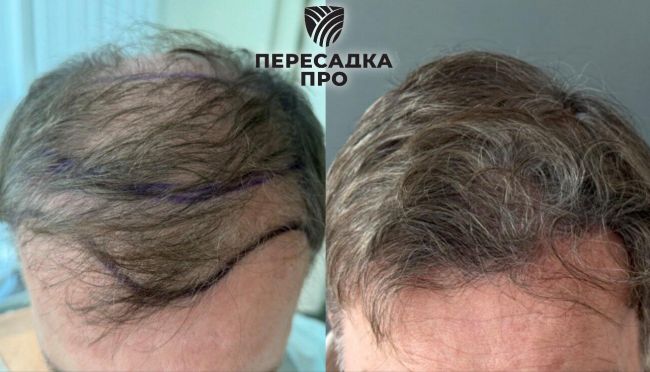 5 степень облысения, пересажено 5500 графтов, результат через 9 месяцев