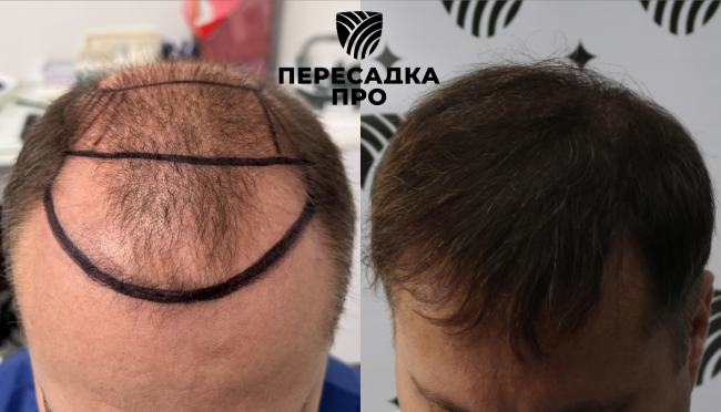 6 степень облысения, пересажено 6000 графтов, результат через 12 месяцев