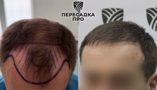 5 степень облысения, пересажено 5500 графтов, результат через 8 месяцев