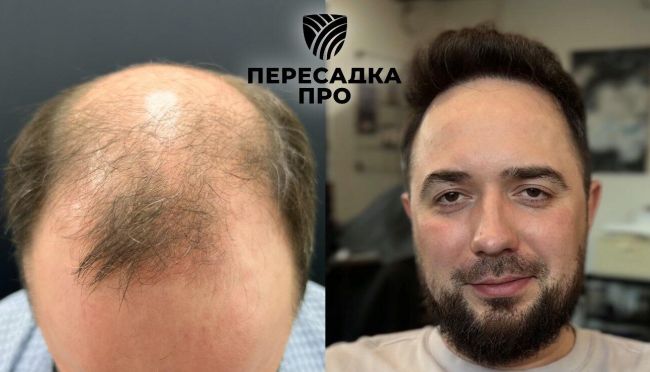7 степень облысения, пересажено 7500 графтов, результат через 6 месяцев после второго этапа