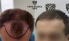 4-5 степень облысения, пересажено 5500 графтов, результат через 8 месяцев