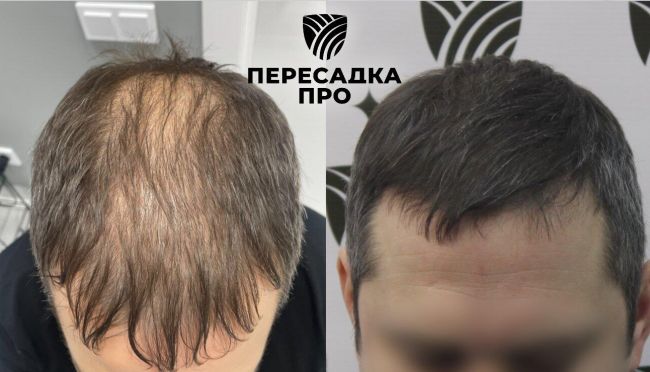 4 степень облысения, пересажено 4000 графтов, результат через 7 месяцев