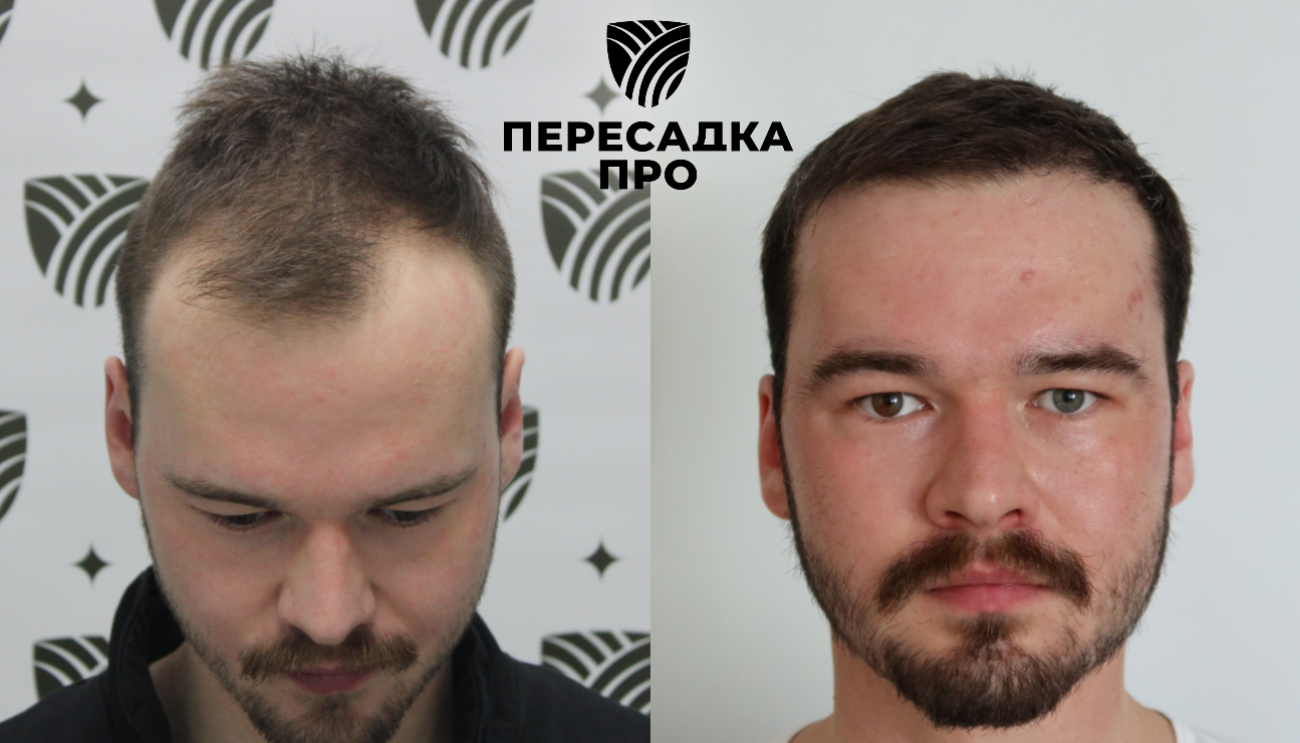 2–3 степень облысения, пересажено 3500 графтов, результат через 3 месяца