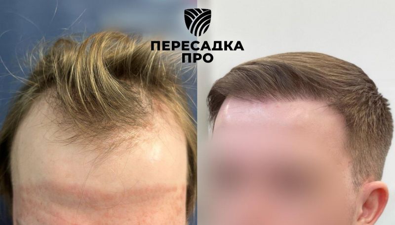 3 степень облысения, пересажено 2500 графтов, результат через 12 месяцев