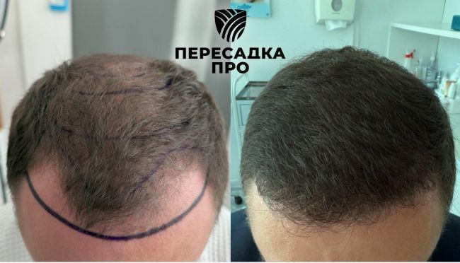 4 степень облысения, пересажено 5500 графтов, результат через 9 месяцев