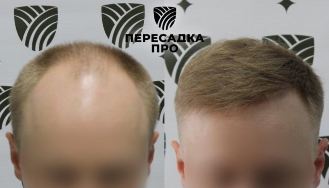 5–6 степень облысения, пересажено 6000 графтов, результат через 9 месяцев