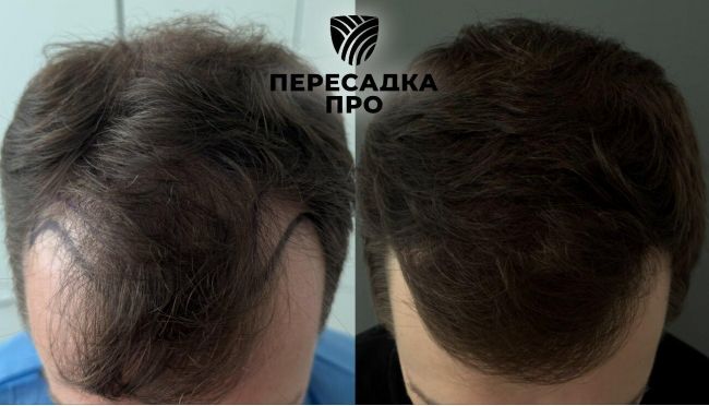 4 степень облысения, пересажено 4500 графтов, результат через 7 месяцев