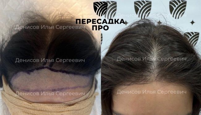 1–2 степень облысения по Людвигу, пересажено 2500 графтов, результат через 8 месяцев