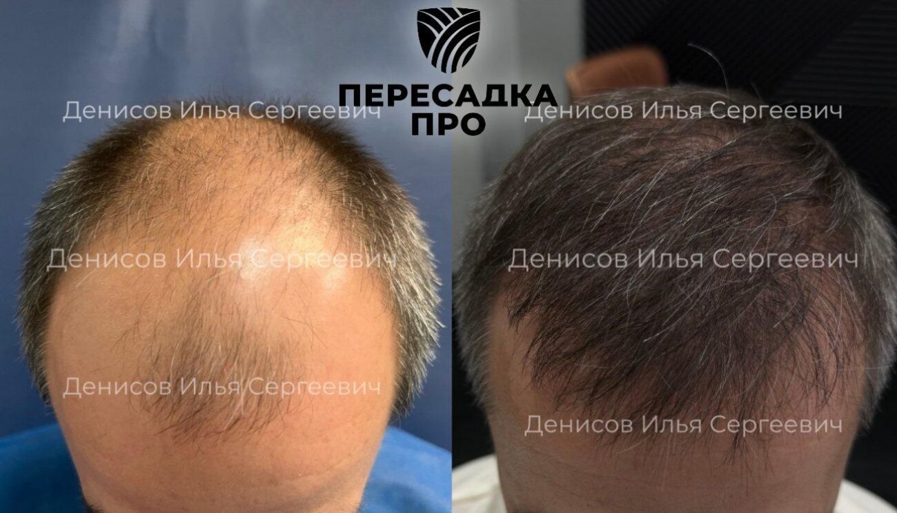 6 степень облысения, пересажено 6000 графтов, результат через 12 месяцев после второго этапа