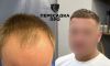 Пересадка 4000 графтов во фронтальную зону и 500 в среднюю